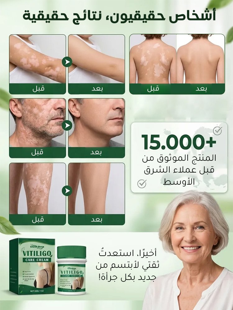 لا داعي لإخفاء البقع البيضاء بالمكياج بعد اليوم!