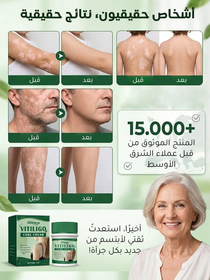لا داعي لإخفاء البقع البيضاء بالمكياج بعد اليوم!