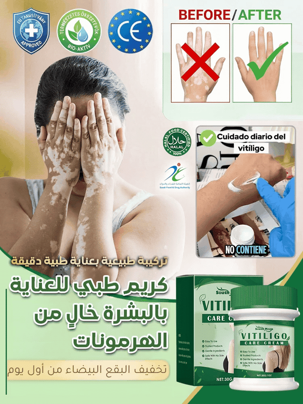 لا داعي لإخفاء البقع البيضاء بالمكياج بعد اليوم!